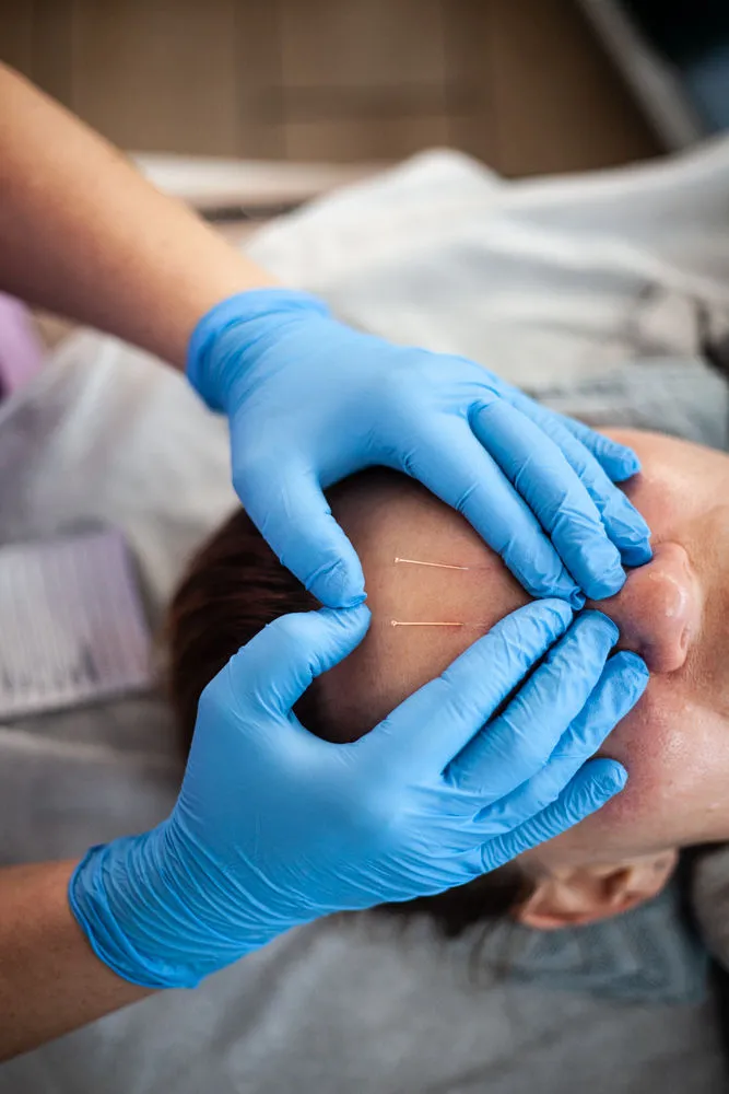 Akupunktura kosmetologiczna